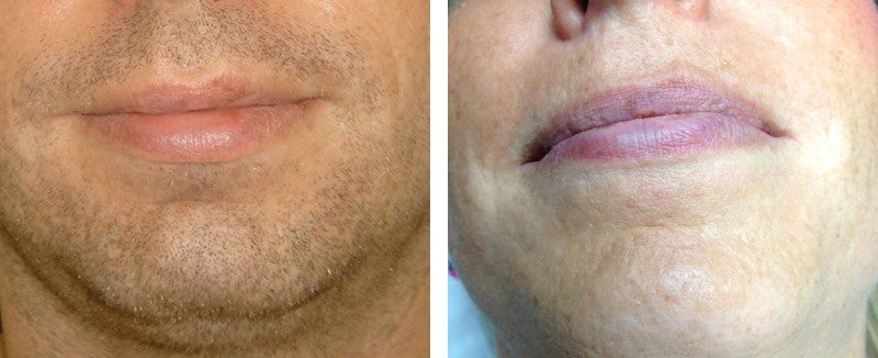 Minidepiladora láser para el hogar, sistema de depilación permanente IPL, 500000 pulsaciones de luz, eliminador de vello de todo el cuerpo